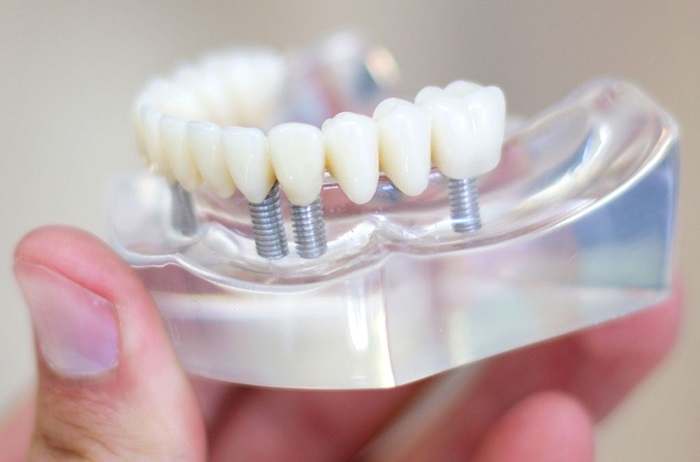 Phẫu thuật cấy ghép Implant: Giải pháp tối ưu cho người bị mất răng lâu năm